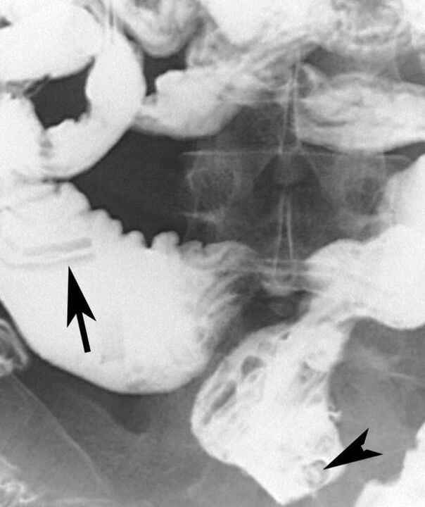 Röntgen auf Spulwürmer im Körper