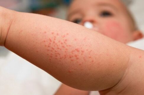 Allergie bei einem Kind als Symptom für das Vorhandensein von Würmern